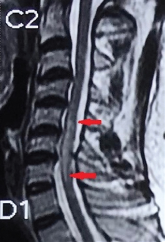 T2W sagittal image of cervical spine showing hyperintensity in cord extending from C5-C7 (red arrows) with cord expansion suggestive of myelitis.
